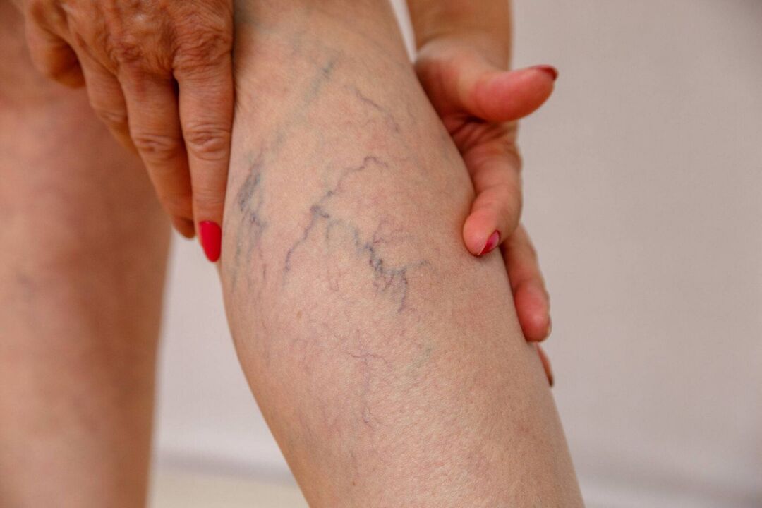 symptoms of varicose veins