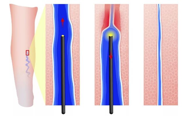Endovasal electrocoagulation