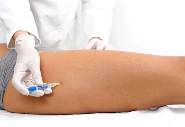 The treatment of varicose veins