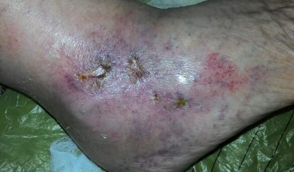 Varicosis complications of the veins