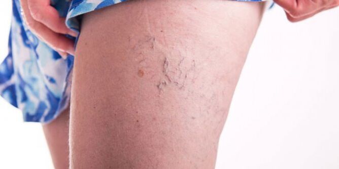 Varicosis veins on the foot