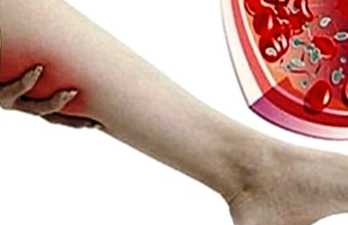 Varicosis veins on the foot