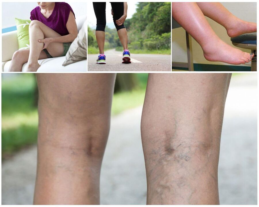 Varicosis Start