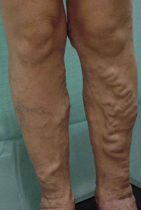 Varicosis veins in the legs