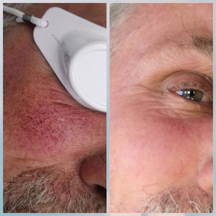 Varicosis veins on the face