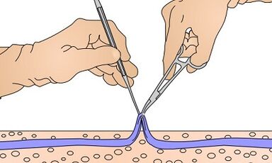 Operation for varicose veins