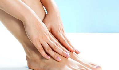 Varicosis of the lower extremities