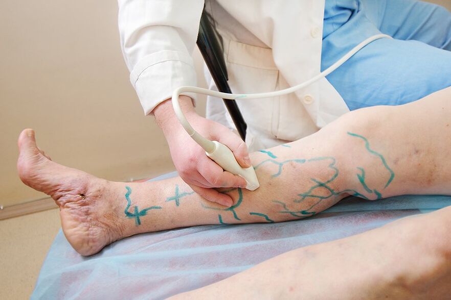 Preparation for miniphlebectomy - marking the perforators of the leg, conducting an ultrasound examination