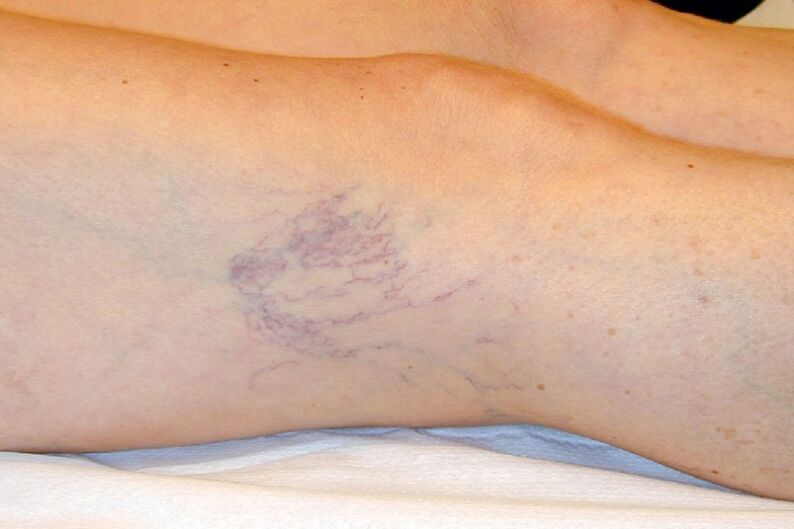 Stage C1 - reticular vessels with a diameter of about 1 mm