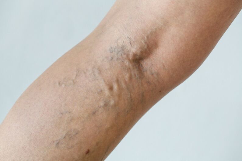 Stage C2 - popliteal varicose veins (Thierry perforator) and reticular veins