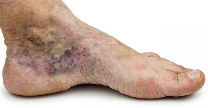 Stage C4c - crown of the foot, phlebitis in the center