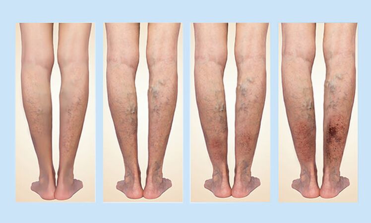 Stages of varicose veins